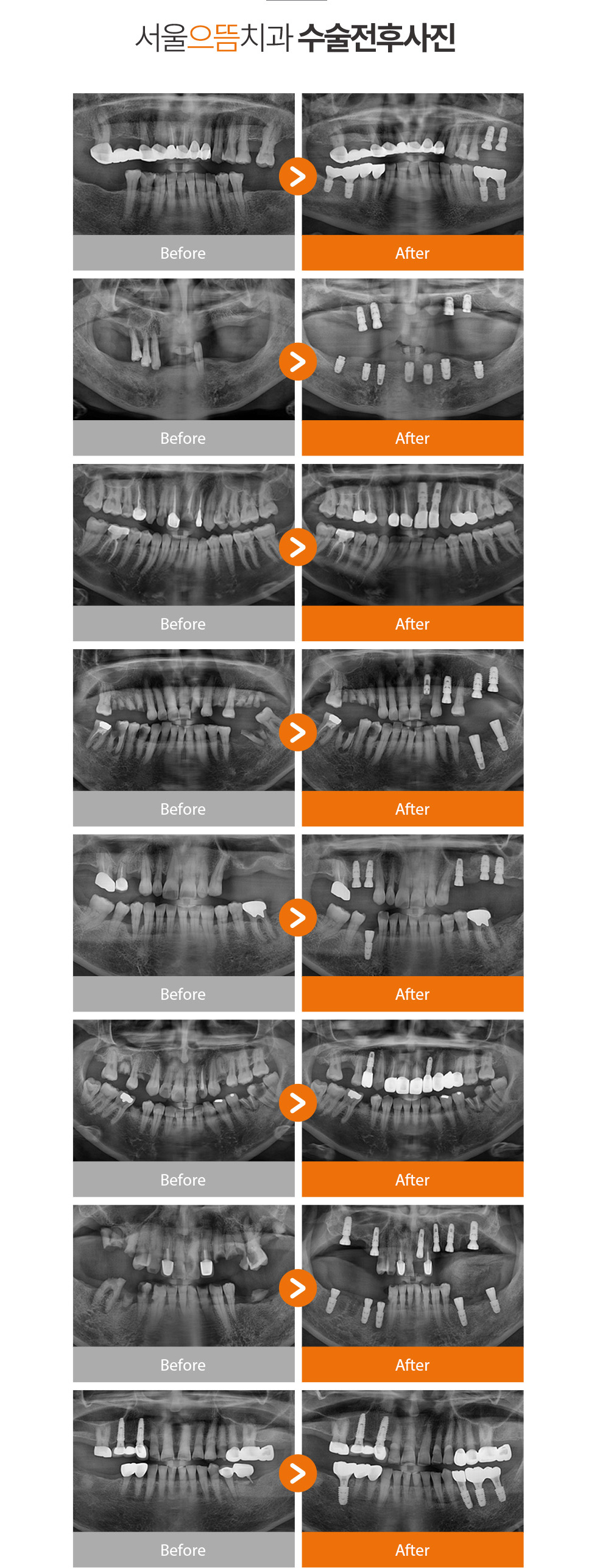서울으뜸치과 치료전후