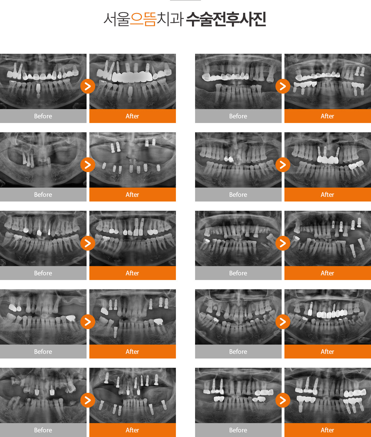 서울으뜸치과 치료전후